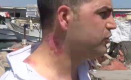 İzmir’de lazer tedavisi sonrası yara izleri belirginleşti: 1 milyon TL’lik tazminat talebi reddedildi