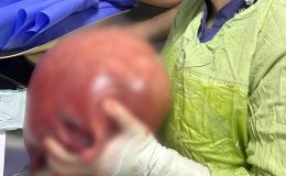 Trabzon’da karın ağrısı şikayetiyle gitti, 5.5 kg kitle çıktı